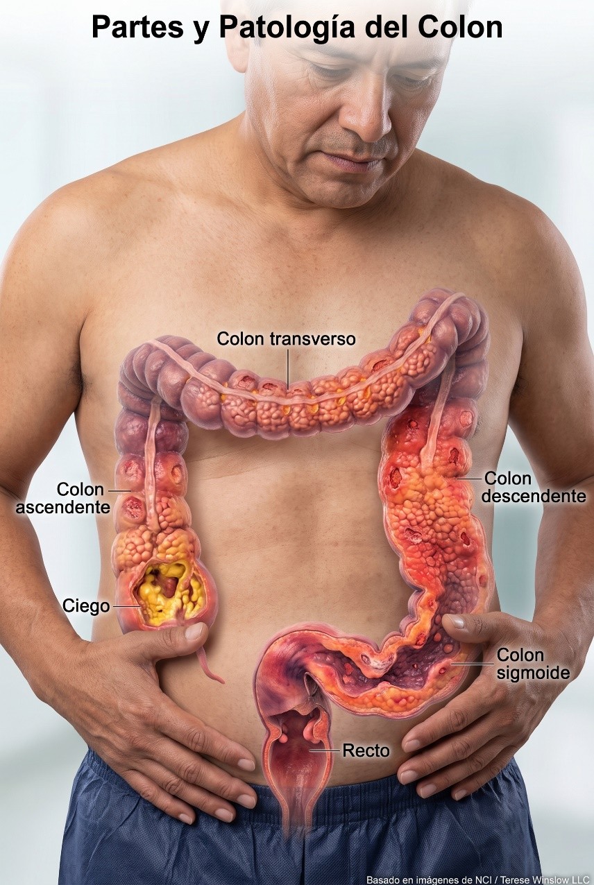 Colitis