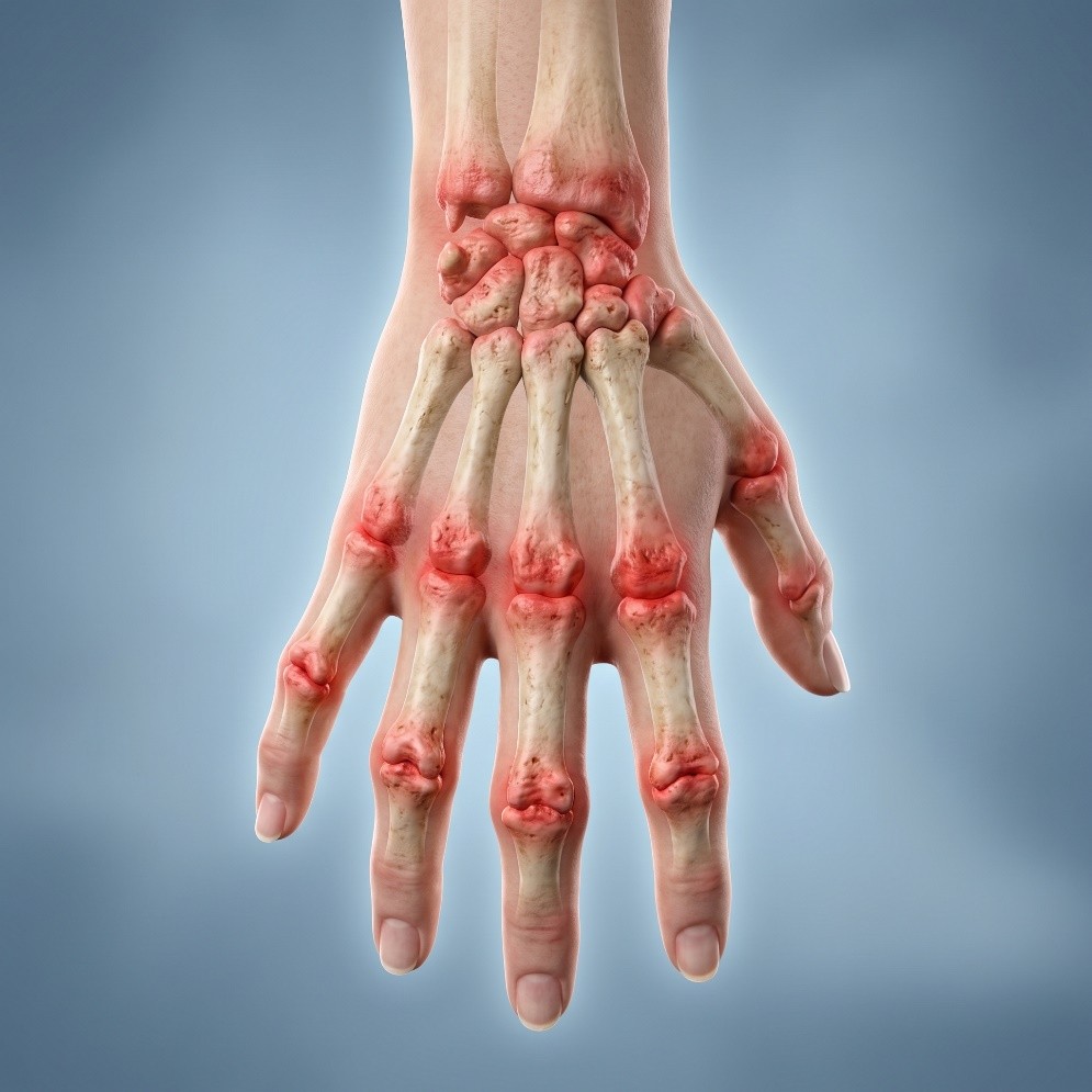 Problemas reumatológicos — atención integrativa con el Dr. Ramón Jiménez